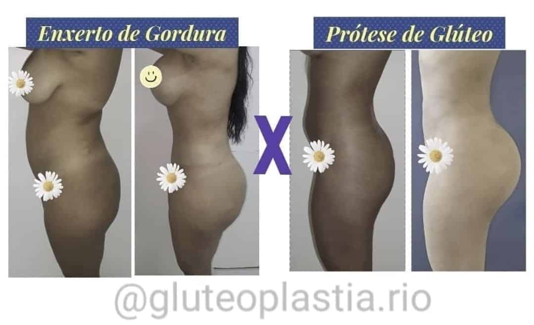 É possível aumentar o volume dos glúteos sem cirurgia?