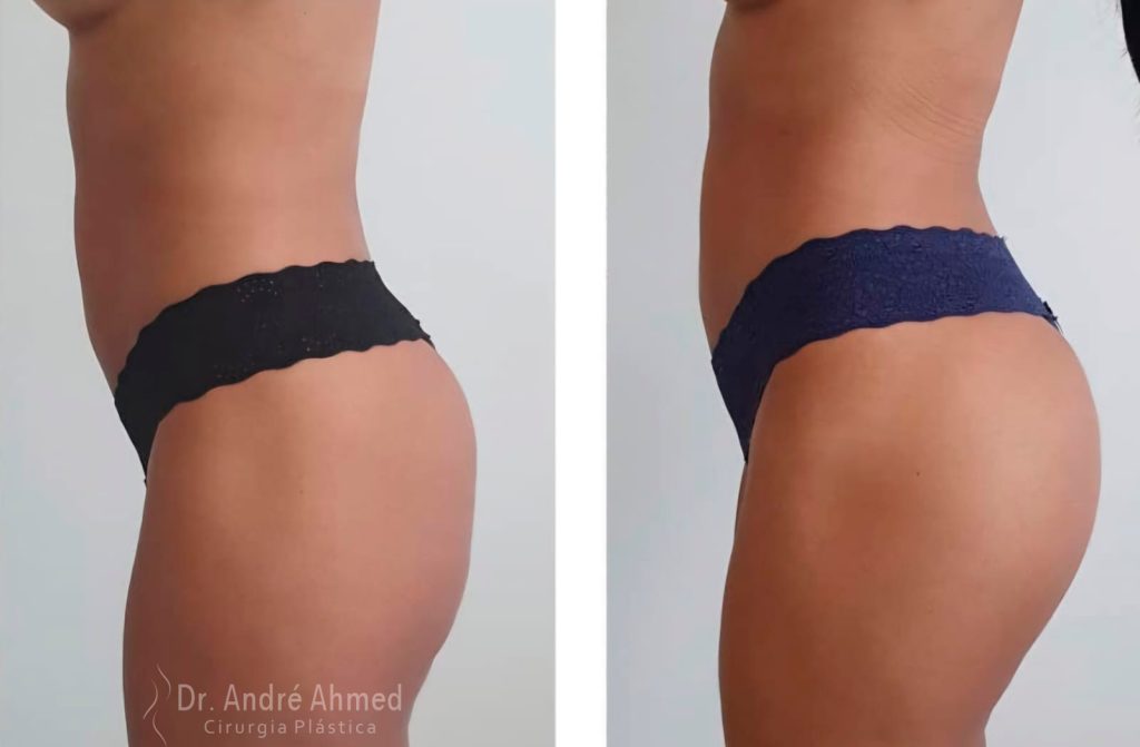 antes e depois