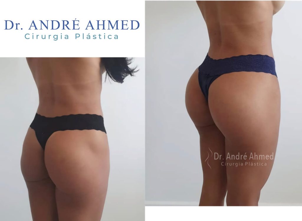 antes e depois1
