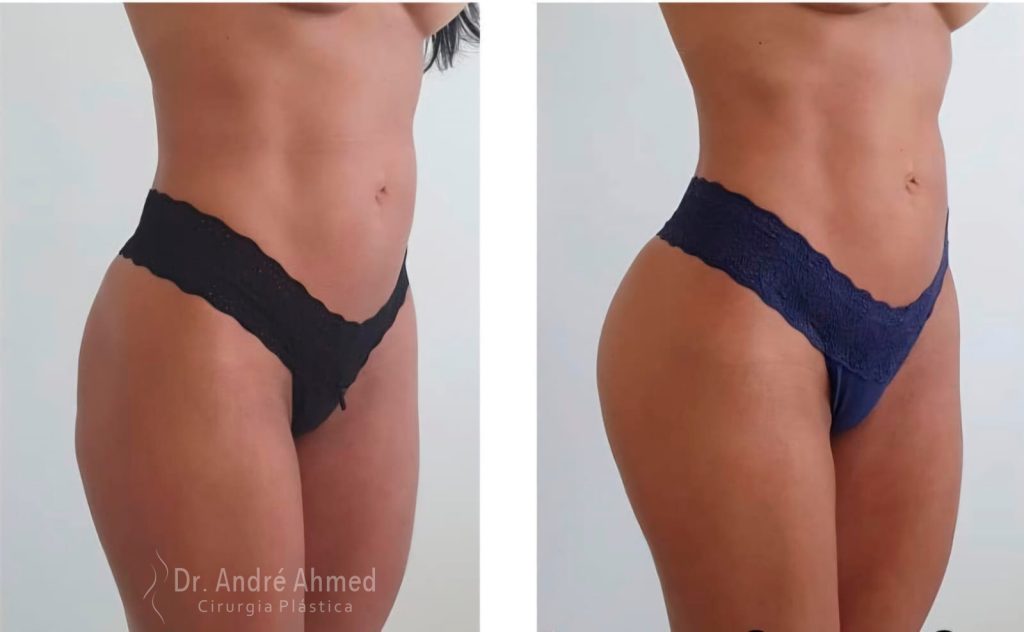 antes e depois2