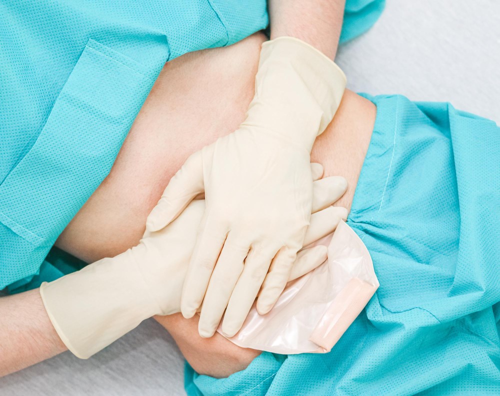 Quando a Abdominoplastia em Ancora e Indicada 2