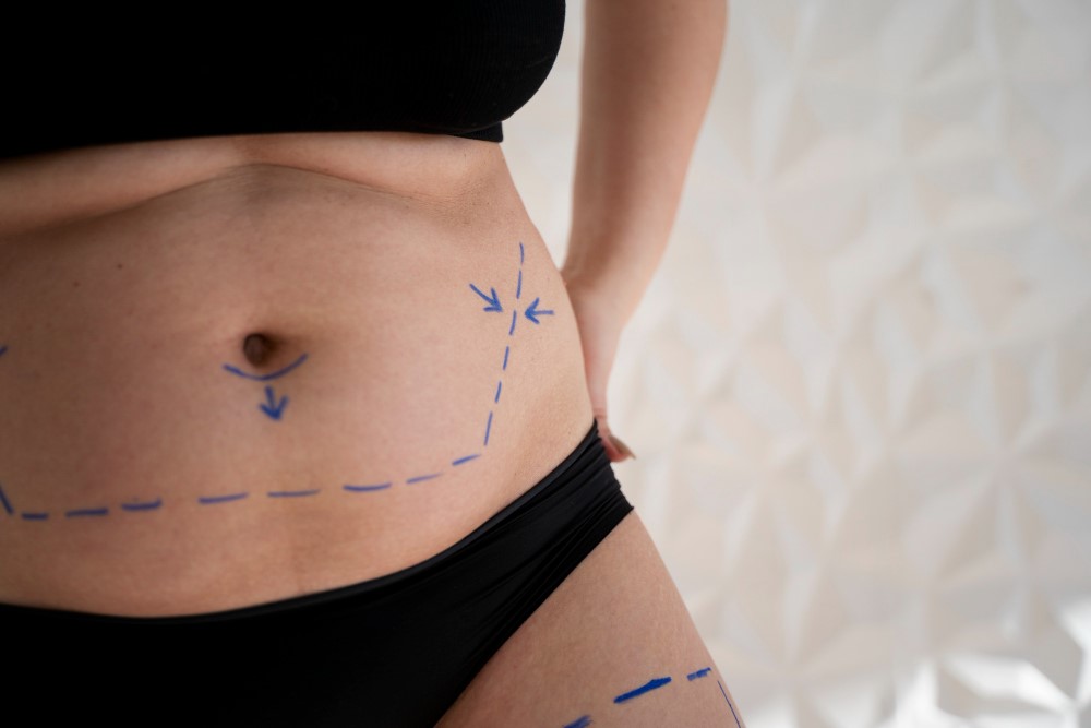 Quais Sao os Tres Tipos de Abdominoplastia 1