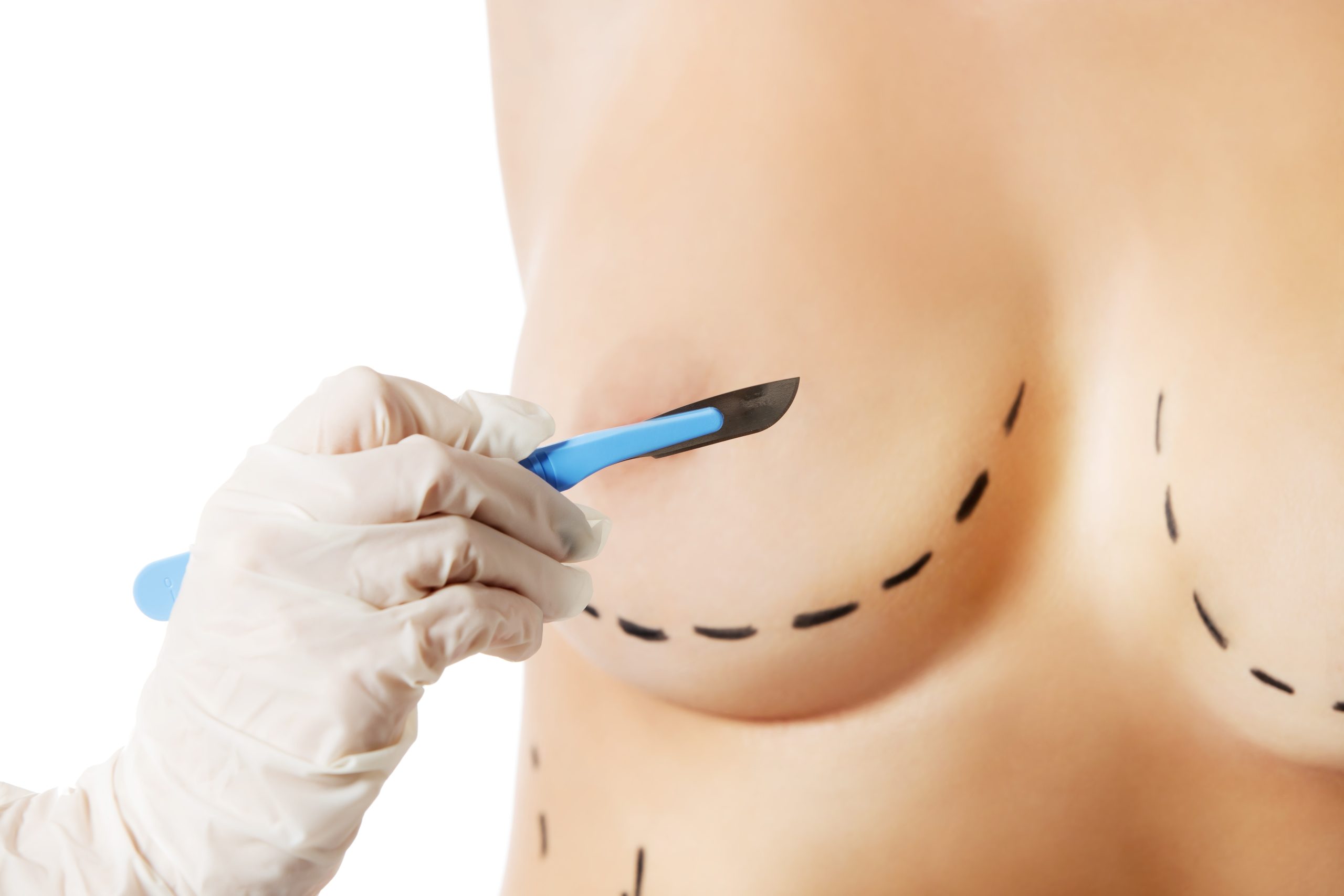 O Que e Cirurgia Mastopexia 2 scaled