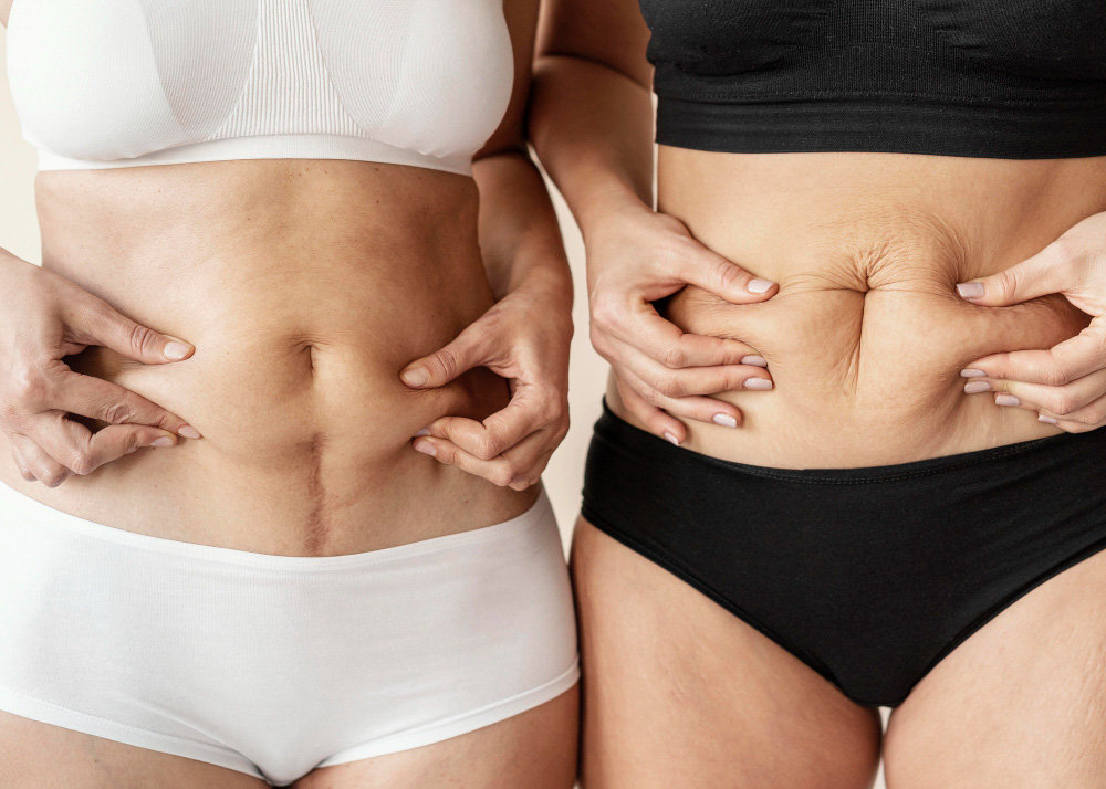 Quanto Tempo Dura uma Abdominoplastia com Lipo 3