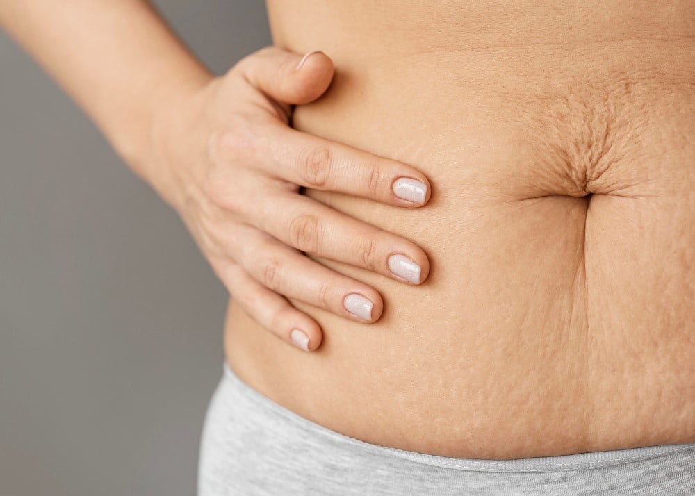 Abdominoplastia PosParto