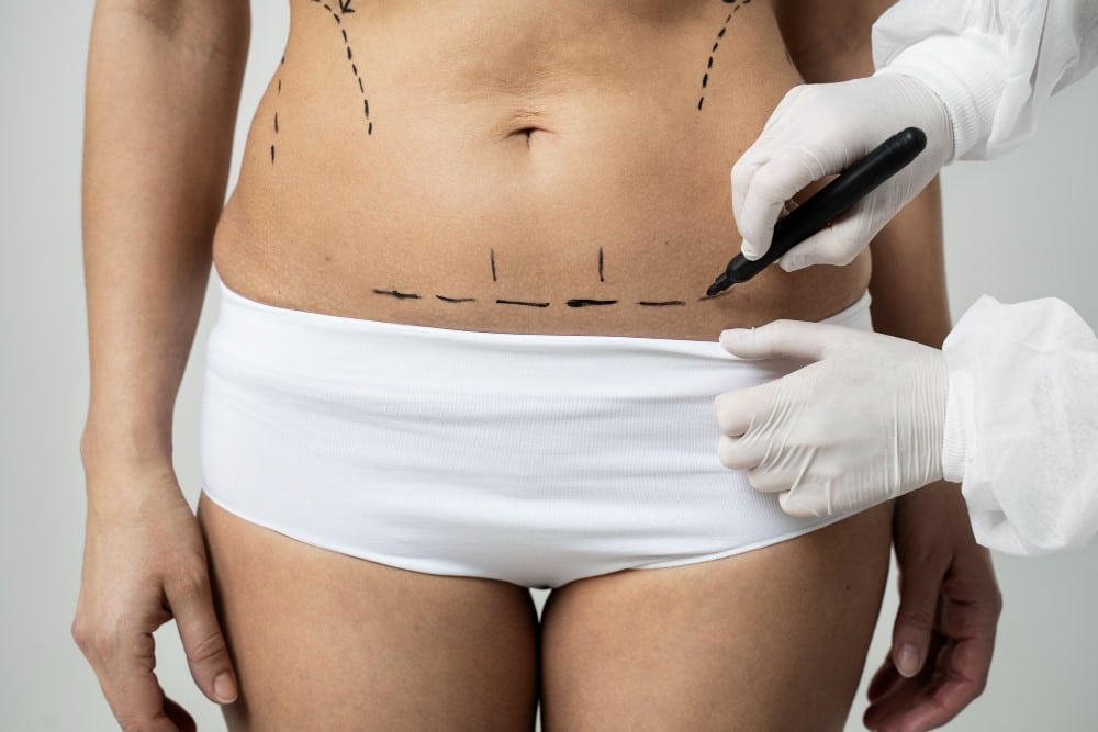 Abdominoplastia com Lipo 1