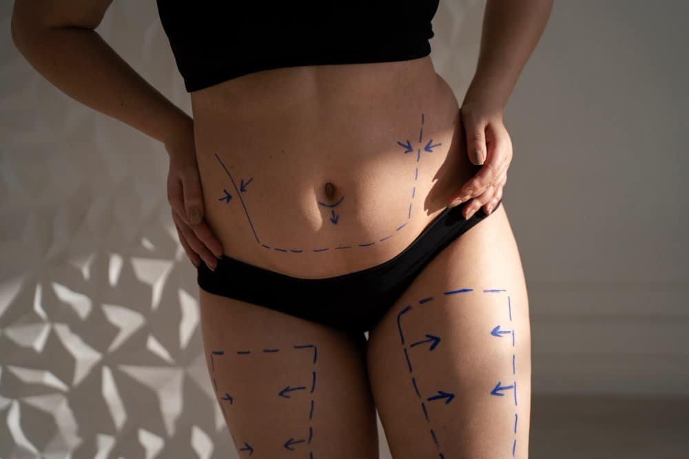 Areas do Corpo para Lipoaspiracao